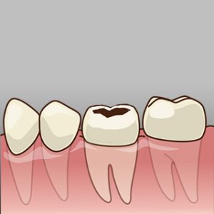 セラミッククラウン STEP-1 虫歯の治療