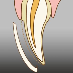 ラミネートベニア STEP-2 つけ歯を仮合わせ