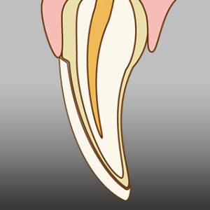 ラミネートベニア STEP-3 つけ歯を本装着