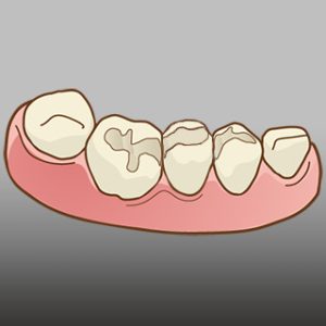 セラミックインレーSTEP1 虫歯を治療