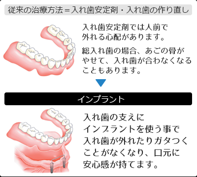 奥歯を失った場合