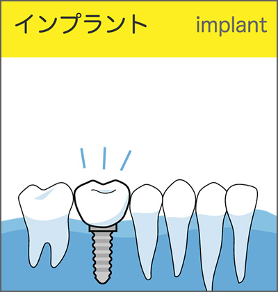 インプラント治療　埋め込みイメージ