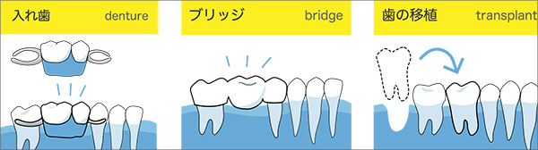インプラント以外の治療法（入れ歯・ブリジッジ・歯の移植）との比較
