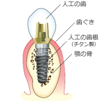 インプラント　構造図