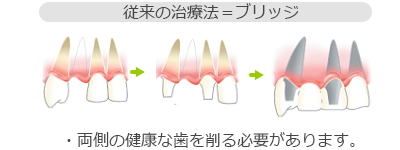 従来の治療法＝ブリッジ