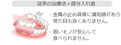 従来の治療法＝部分入れ歯