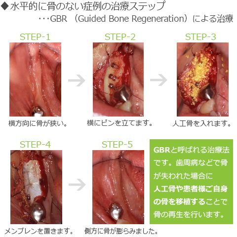 水平に骨のない症例
