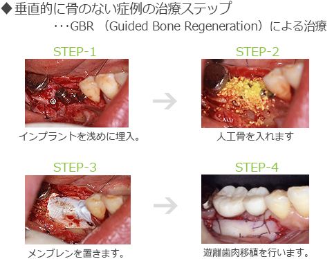 垂直的に骨のない症例の治療ステップ