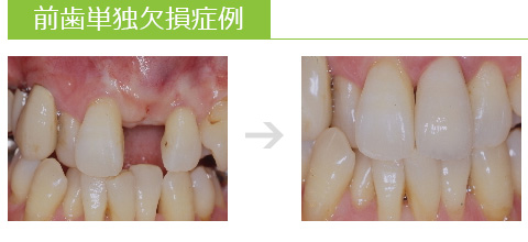 前歯単独欠損症例 