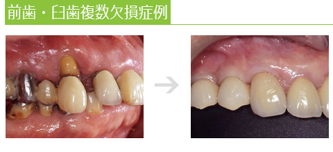 前歯・臼歯複数欠損症例 