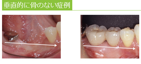 垂直的に骨のない症例 