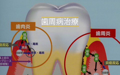 歯周病治療