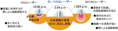 Er:YAGレーザー Erwin Adverlアーウイン　アドベール）